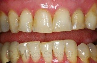Primo piano di denti e gengive ingialliti, con evidente scolorimento e allineamento irregolare.
