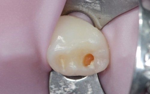 Primo piano di un dente con una piccola carie arancione vicino al bordo