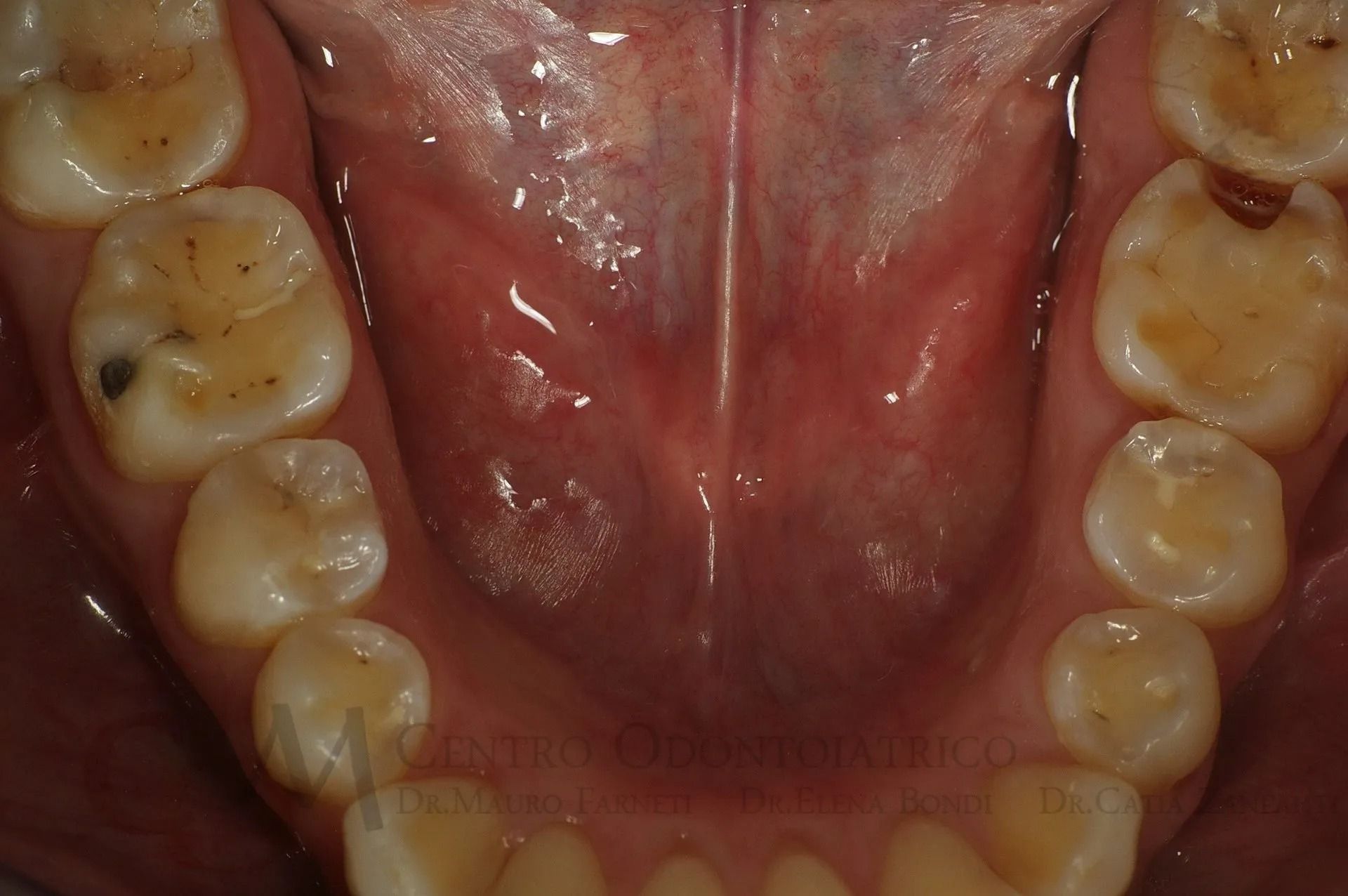 Primo piano dell'arcata dentale inferiore e della lingua, che mostra i molari e il pavimento della bocca.