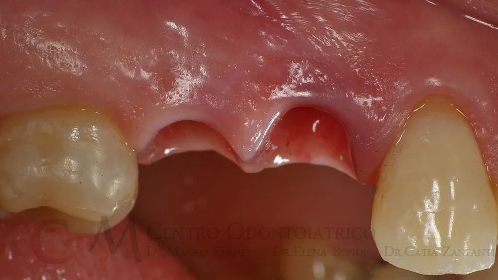 Primo piano dei denti frontali superiori con incisivi centrali mancanti e gengive rosa visibili.