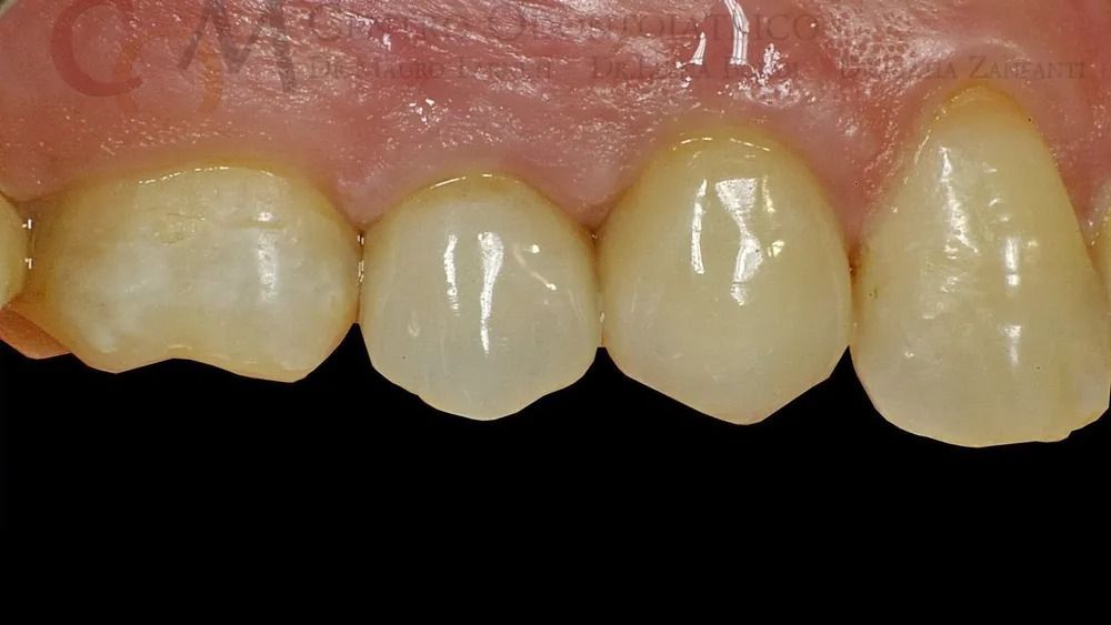 Primo piano dei denti frontali superiori con macchie gialle e uno spazio vuoto