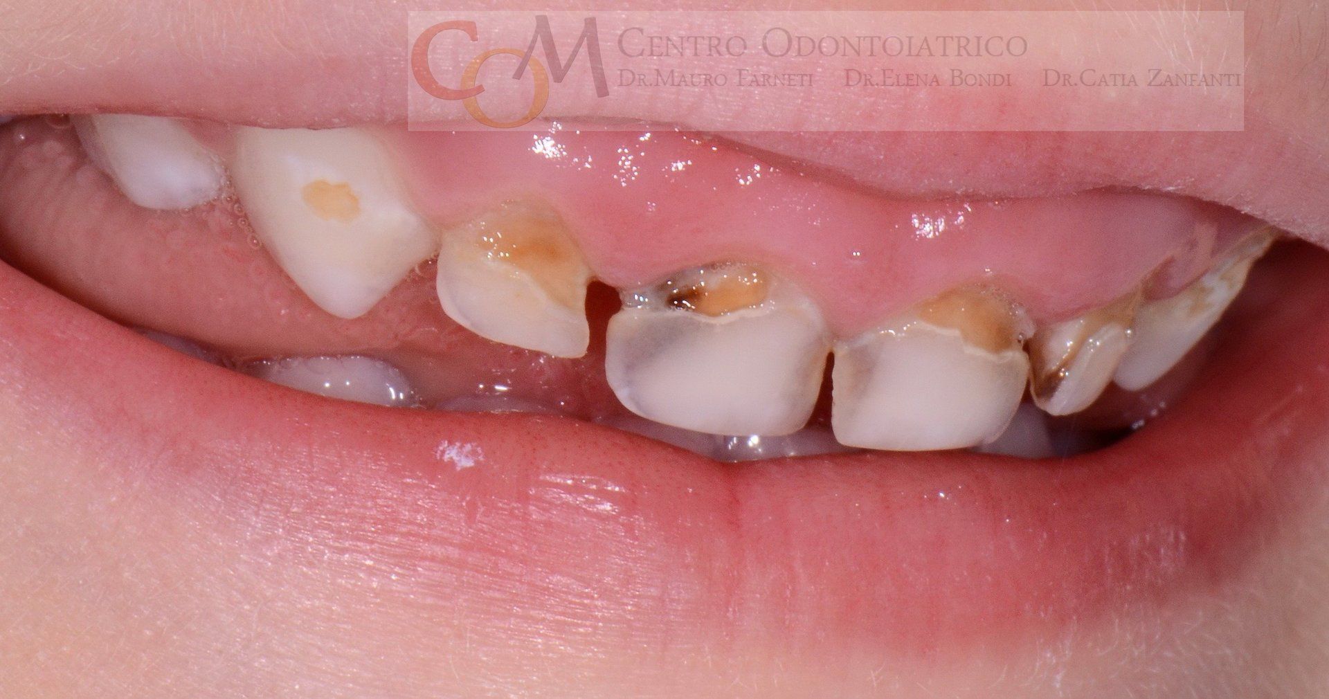 Primo piano della bocca di un bambino che mostra i denti frontali cariati, scheggiati e scoloriti.