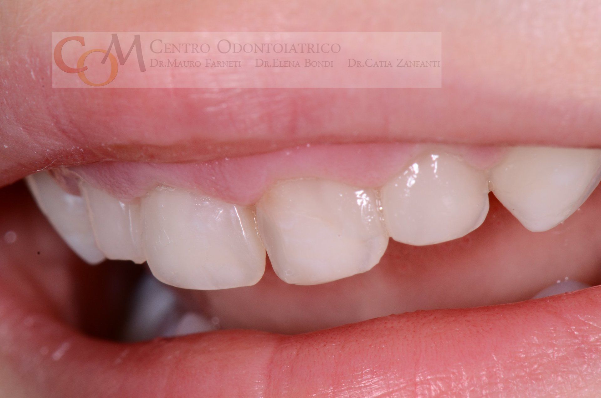 Primo piano di denti incisivi superiori bianchi con un leggero spazio tra di loro e labbra rosa.