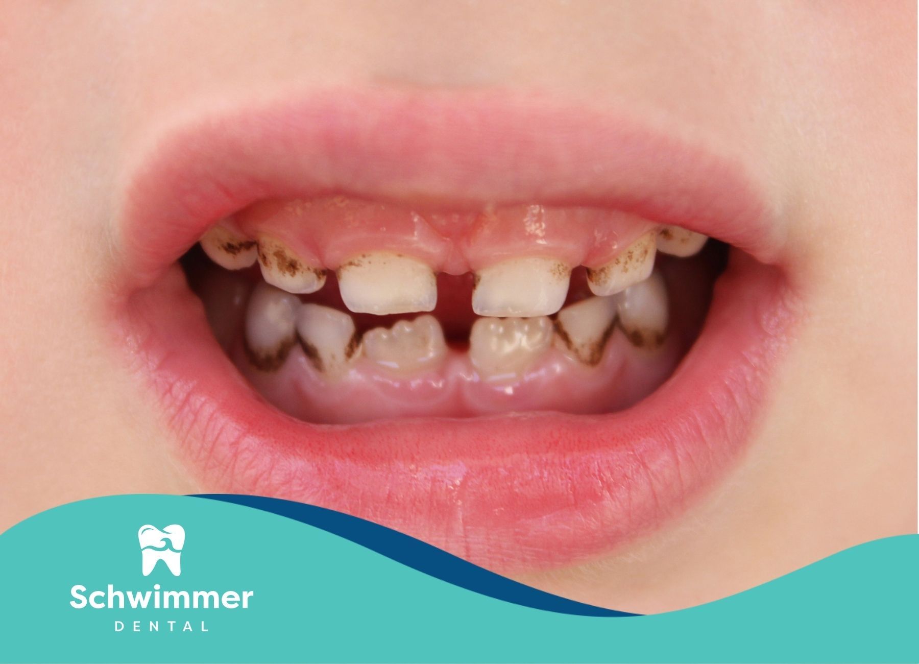 Close-up of a child's upper front teeth showing cavities and brownish-grey discoloration