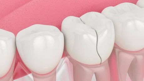 a computer generated image of a cracked tooth .