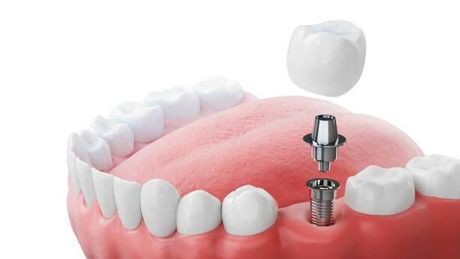 a 3d rendering of a dental implant in a mouth .