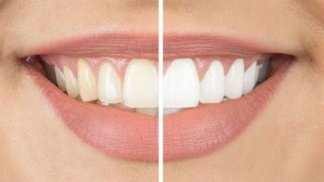 a close up of a woman 's teeth before and after whitening .