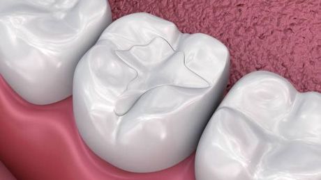 a close up of a tooth with a filling in it .