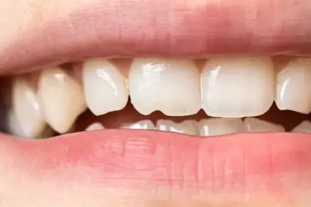 Close-up of a chipped front tooth at Robert A. Lantzy DMD, Chipped or Broken Tooth treatment in Newtown, PA
