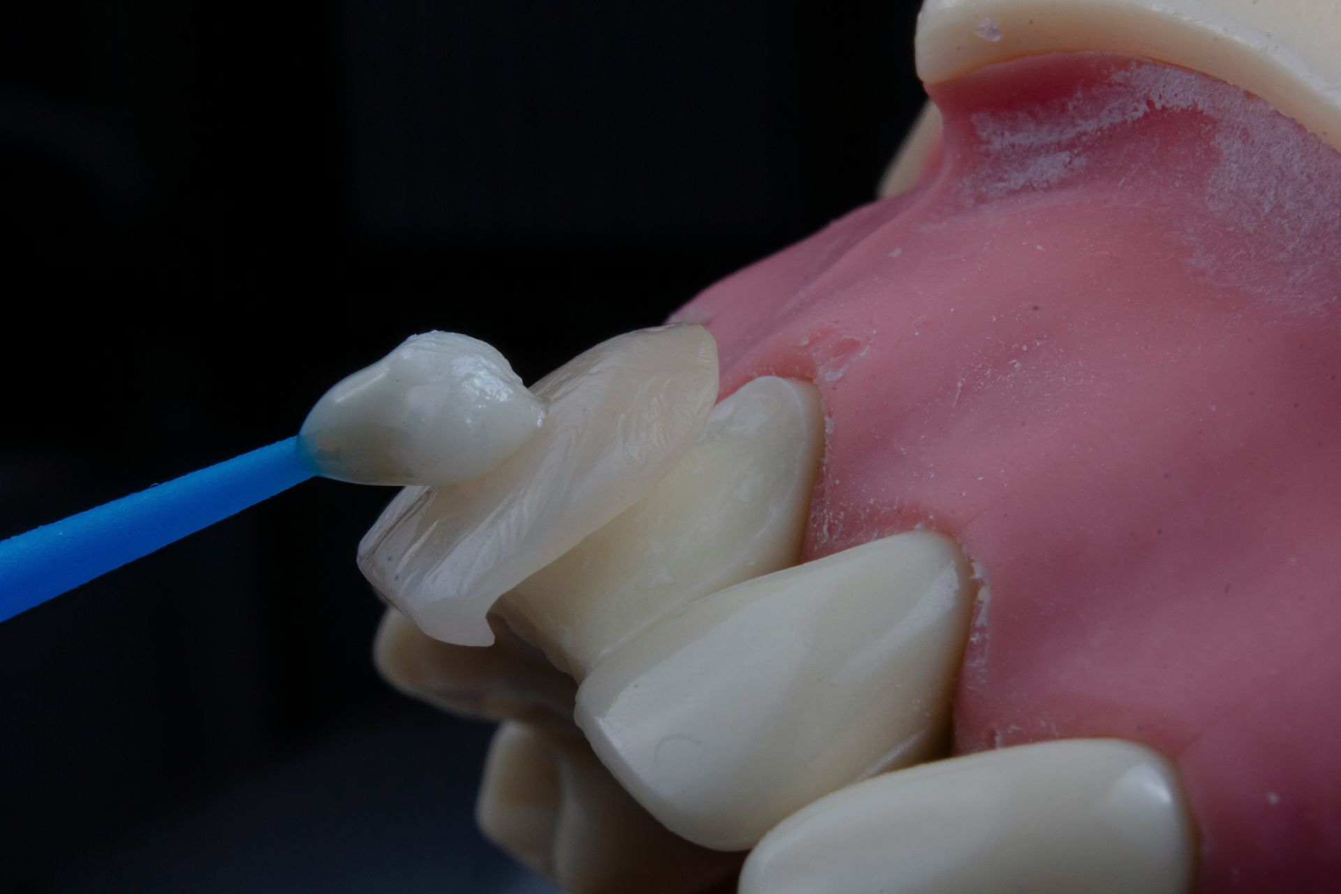Composite bonding restoration at Robert A. Lantzy DMD, Cosmetic Bonding in Newtown, PA