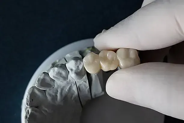 Dental bridge restoration on a model at Robert A. Lantzy DMD, Dental Bridges in Newtown, PA