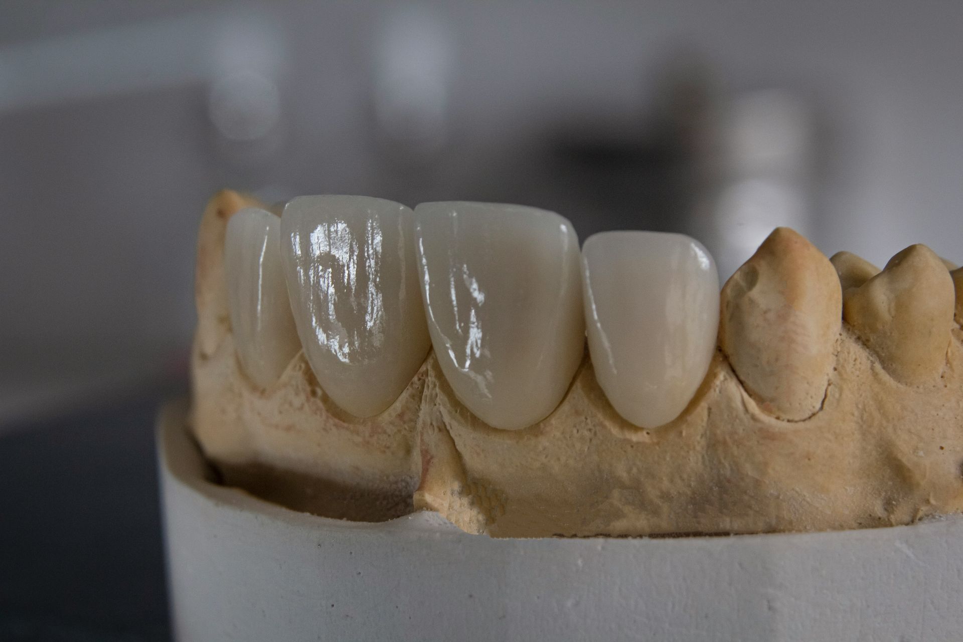 Dental implant crown restoration at Robert A. Lantzy DMD, Implant Restorations in Newtown, PA