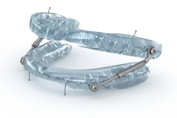 Custom oral sleep appliance at Robert A. Lantzy DMD, Oral Appliance Therapy in Newtown, PA