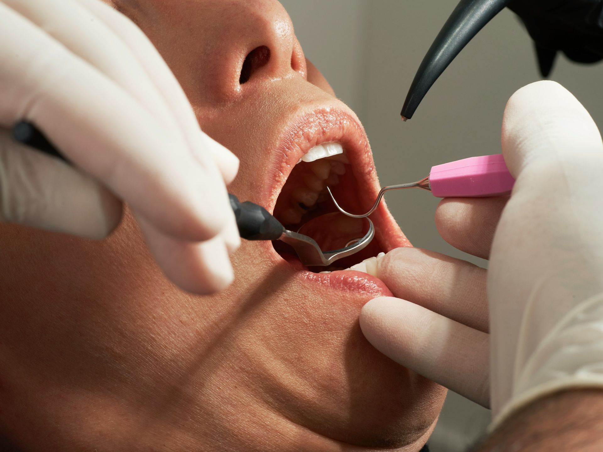 Dentist treating a cavity at Robert A. Lantzy DMD, Tooth-Colored Fillings & Cavities in Newtown, PA