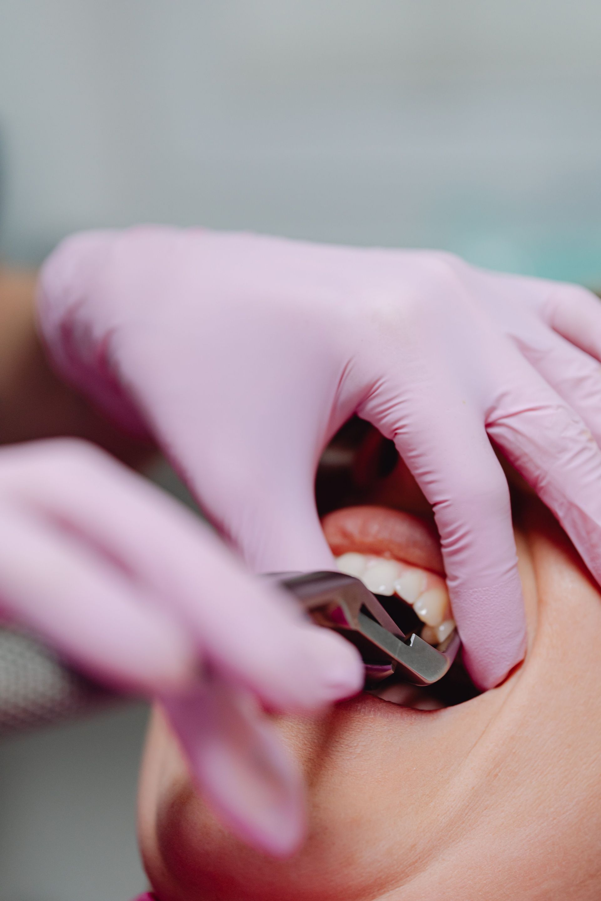 Close-up of a tooth extraction procedure at Robert A. Lantzy DMD, Tooth Extractions in Newtown, PA