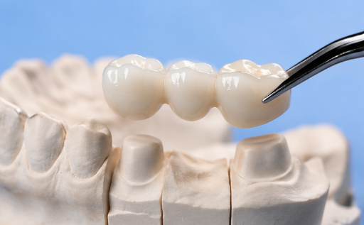 Dental Bridge fabrication at Robert A. Lantzy DMD, Dental Bridges in Newtown, PA