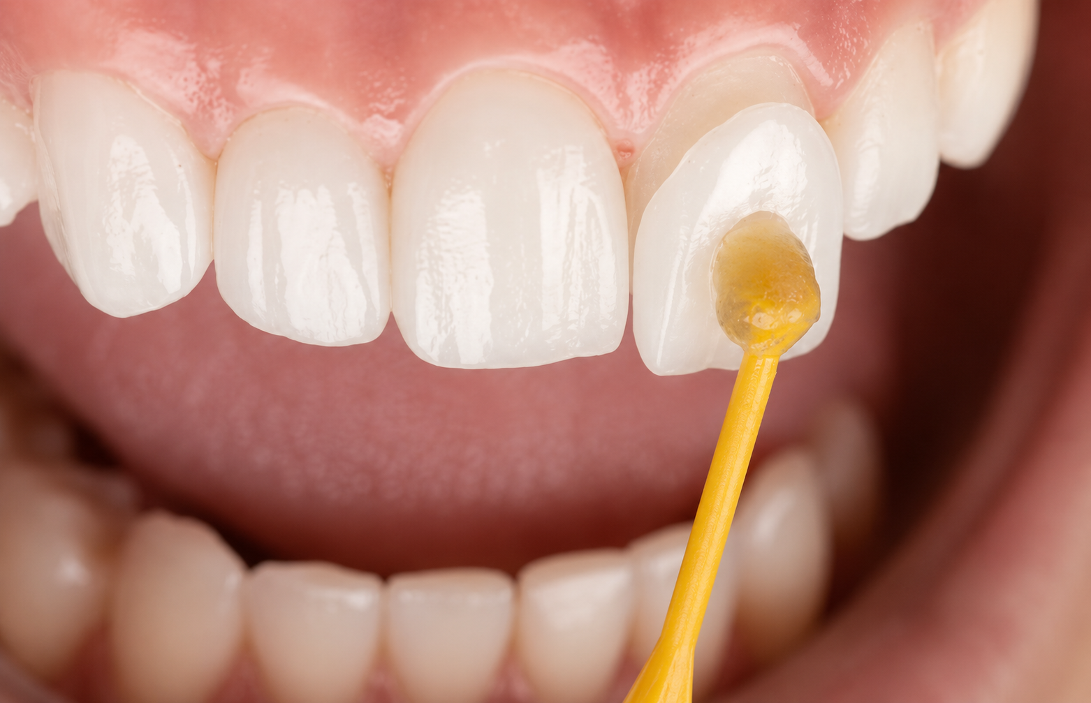 Dental bonding material applied for Porcelain Veneers at Robert A. Lantzy DMD in Newtown, PA