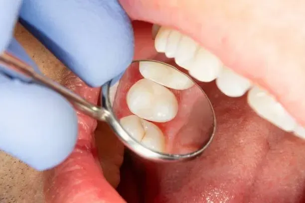 Dental sealant protecting a molar at Robert A. Lantzy DMD, Dental Sealants in Newtown, PA