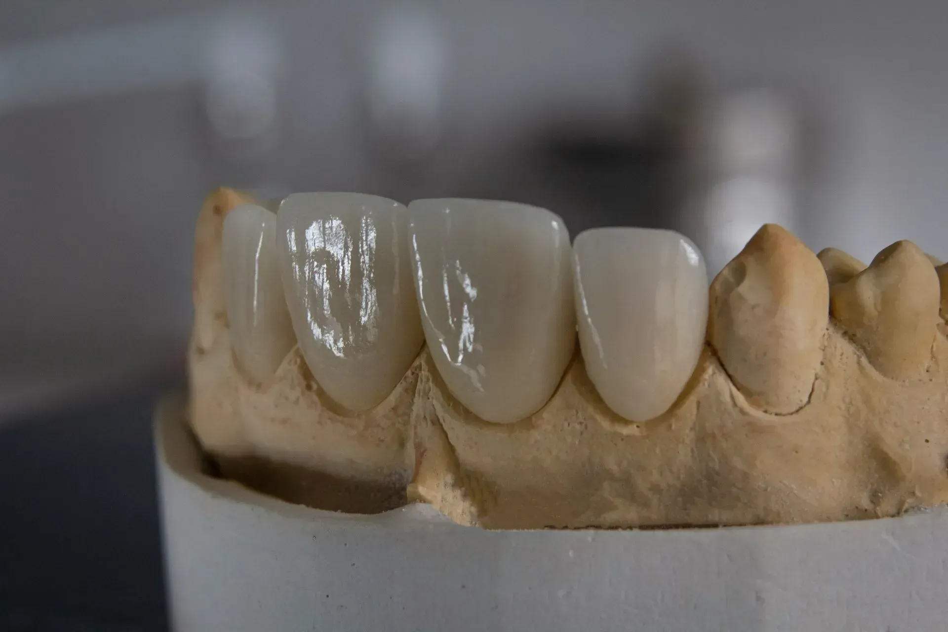 Dental implant crown restoration at Robert A. Lantzy DMD, Implant Restorations in Newtown, PA