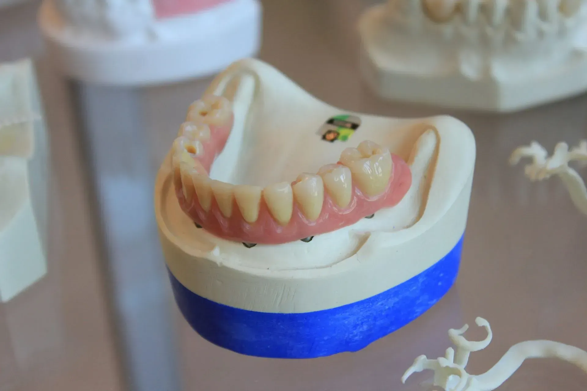 Implant denture model at Robert A. Lantzy DMD, Implant Restorations in Newtown, PA