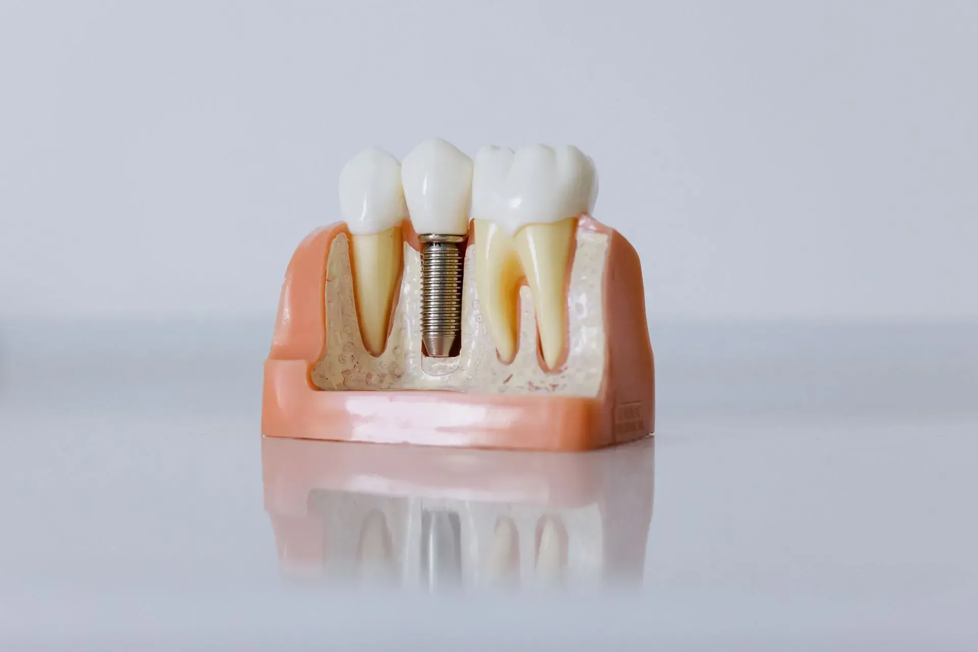 Dental implant model at Robert A. Lantzy DMD, Implant Restorations in Newtown, PA