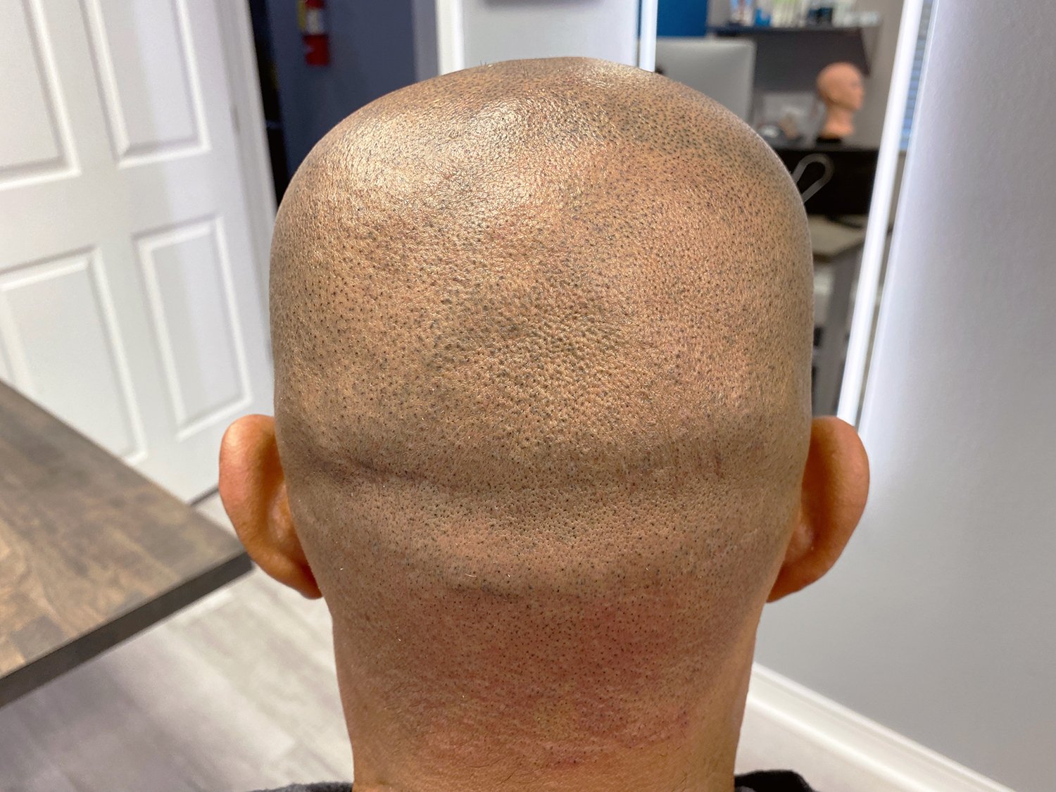 Hair Transplant Scar Cover Up Using Scalp Micropigmentation