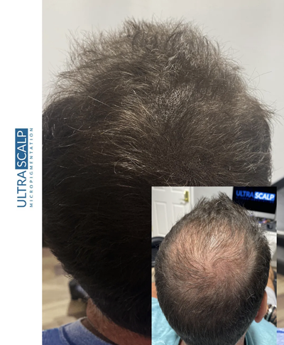 Scalp Micropigmentation Tampa