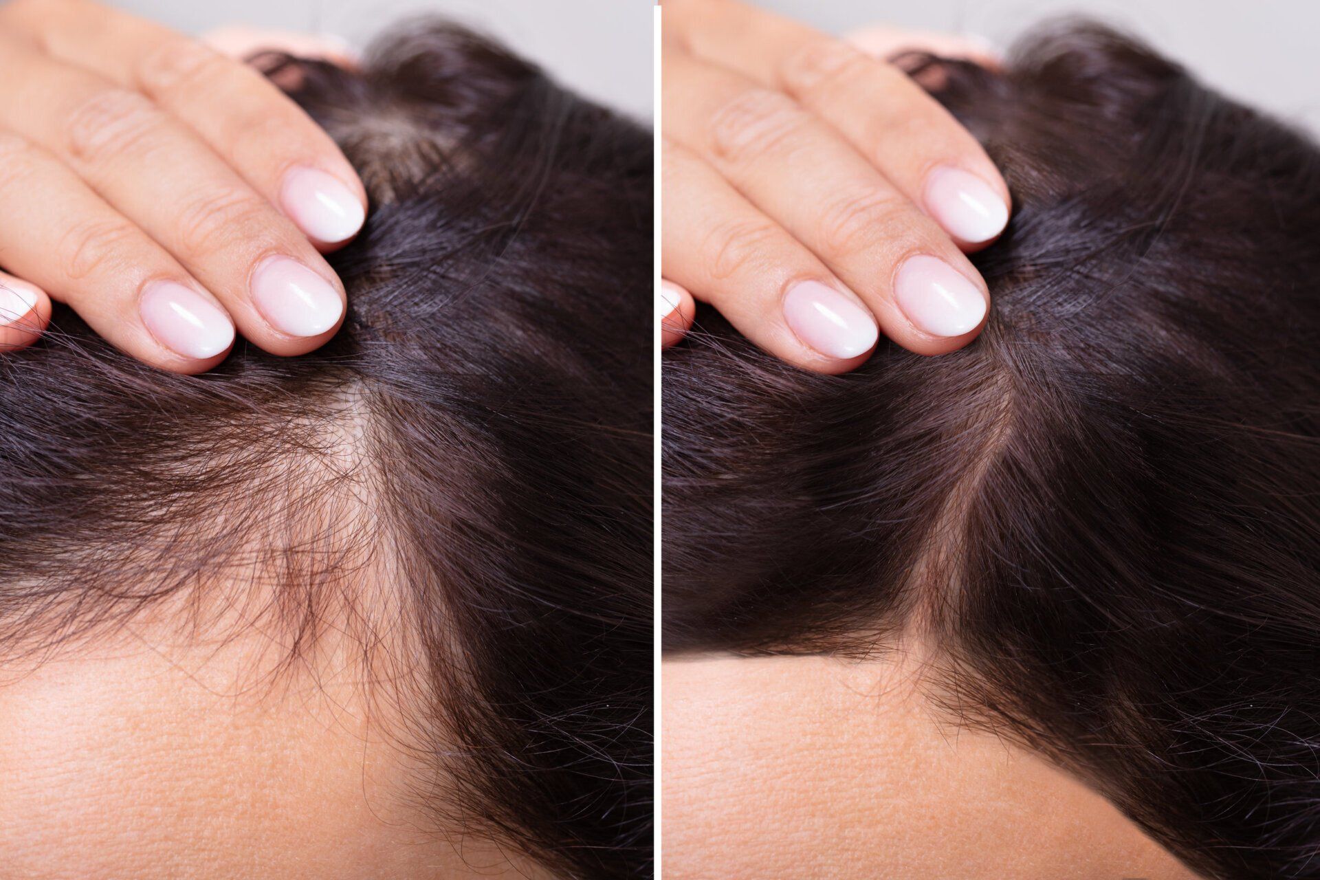 Difference between hair transplant and scalp micropigmentation