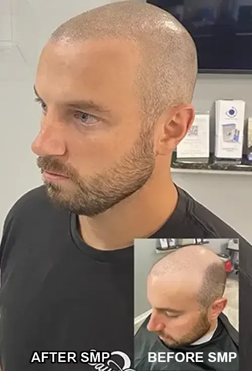 Before and after Natural looking scalp micropigmentation SMP at our Tampa location