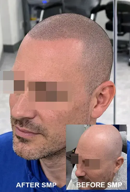 Before and after Natural looking scalp micropigmentation at our Tampa FL location