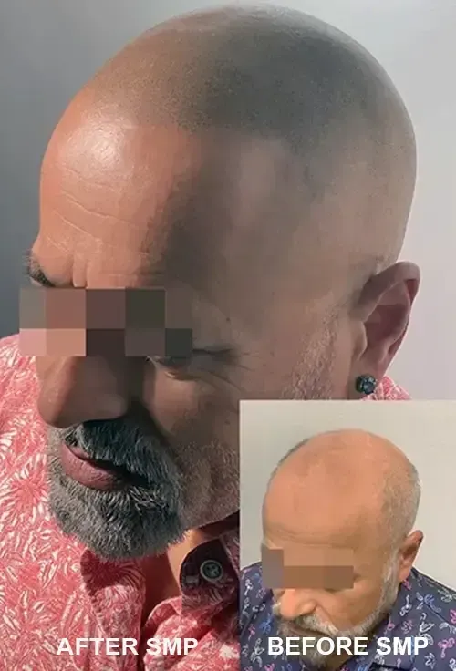 Before and after Natural looking scalp micropigmentation actual client