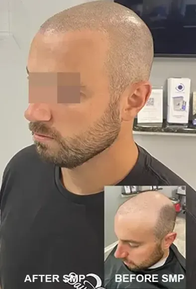 Scalp Micropigmentation Before And After (Actual Client) scalp micropigmentation thinning hair