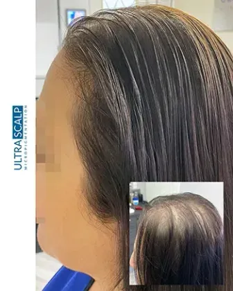 Scalp Micropigmentation For Thin Hair Before And After (Actual Client) scalp micropigmentation thinning crown and vertex tampa