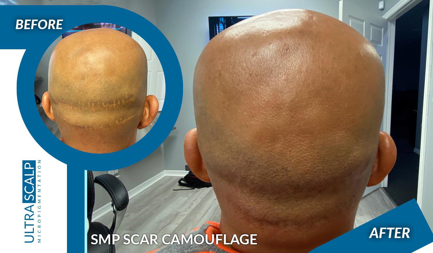 Benefits of FUT or FUE hair transplant scars