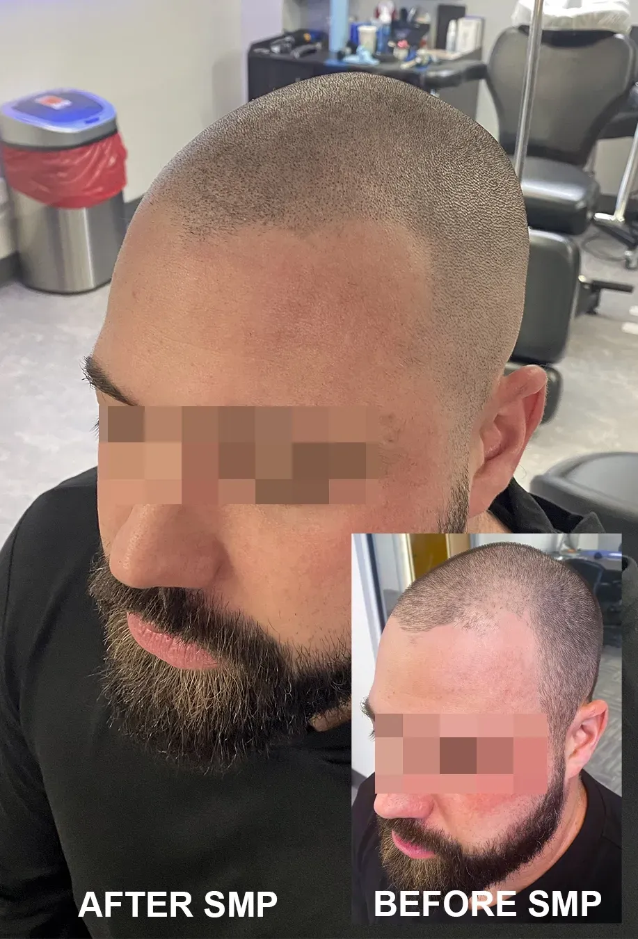 Need to finance your scalp micropigmentation Tampa? How much is scalp micropigmentation Tampa - Financing SMP Tampa