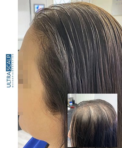 Scalp Micropigmentation Before And After (Actual Client) scalp micropigmentation for fixing hairline Shaved head look
