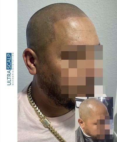 Scalp Micropigmentation Before And After (Actual Client) scalp micropigmentation for fixing hairline Shaved head look