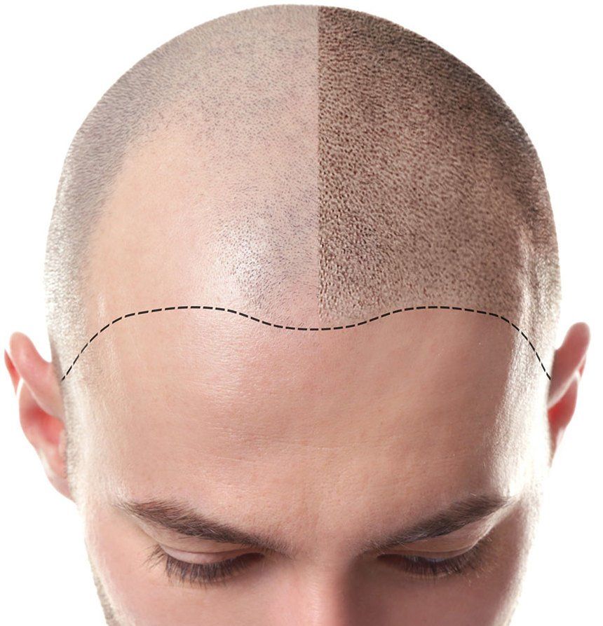 Things to know prior to hair tattoo treatment