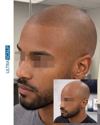 Scalp Micropigmentation For Thin Hair Before And After (Actual Client) scalp micropigmentation after hair transplant Tampa