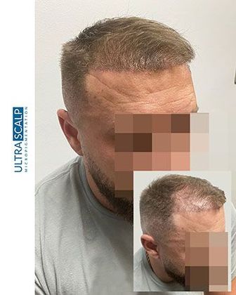Scalp Micropigmentation after a healed hair transplant can fill in the areas that still remain thin. Client underwent 4 SMP treatments to accomplish this look scalp micropigmentation for females with hair loss