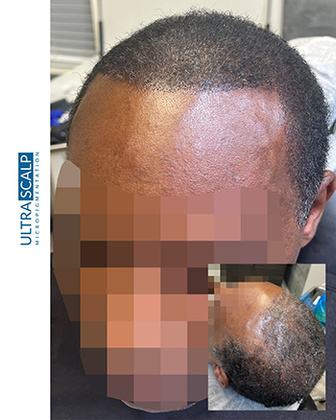Scalp Micropigmentation For Thin Hair Before And After Picture scalp micropigmentation Density tampa