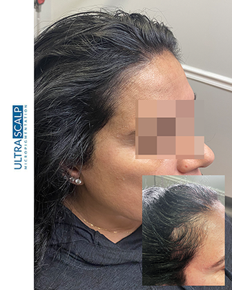 Scalp Micropigmentation For Thin Hair Before And After (Actual Client) scalp micropigmentation for females with hair loss