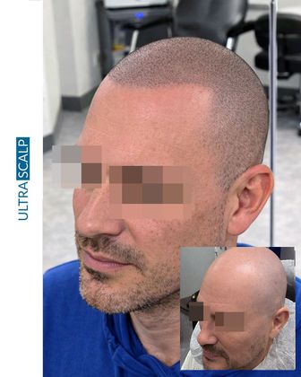 Scalp Micropigmentation For Thin Hair Before And After (Actual Client) scalp micropigmentation for females with hair loss