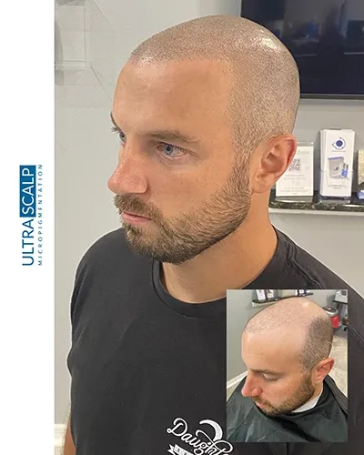 Scalp Micropigmentation For Thin Hairline Before And After (Actual Client)