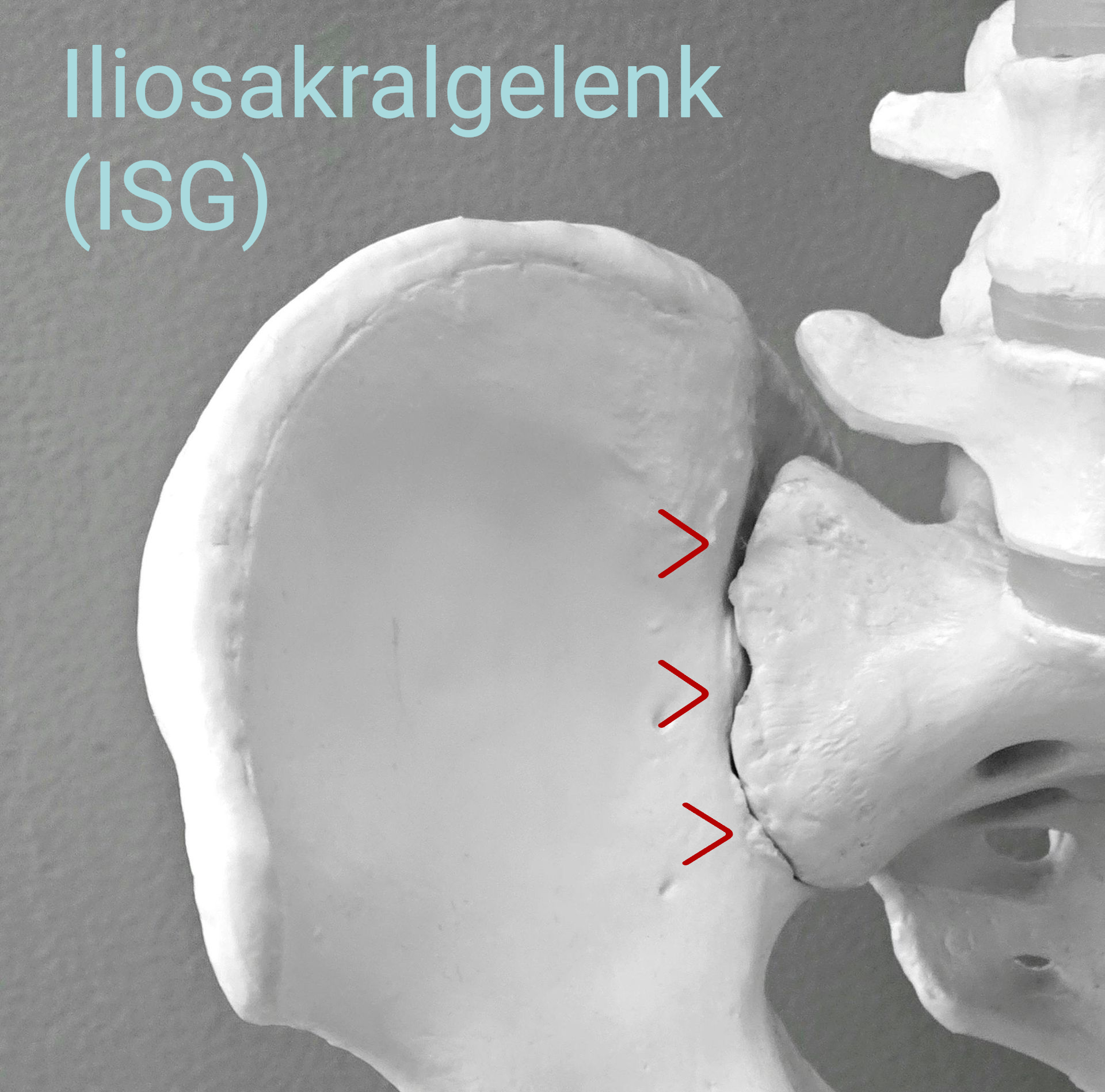 Therapeutische Untersuchung von ISG-Schmerzen im unteren Rücken und Beckenbereich