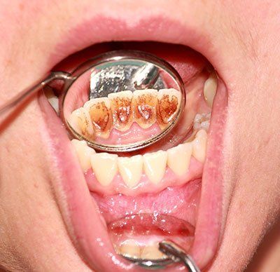 Periodontologinis gydymas - Prieš