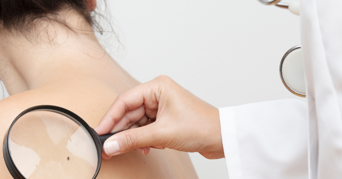 Dermatologe prüft Muttermal Sternen Apotheke Winterthur AG