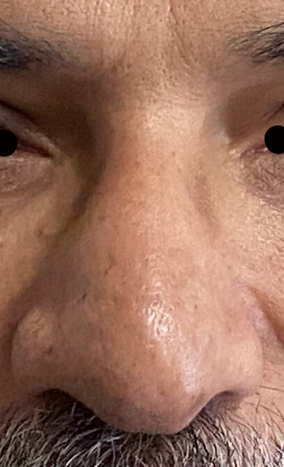 nose after treatment