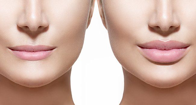 Before and after photo of fillers