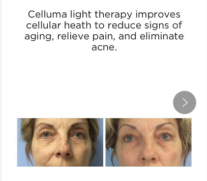 Celluma light therapy improves cellular heath to reduce signs of aging , relieve pain , and eliminate acne.